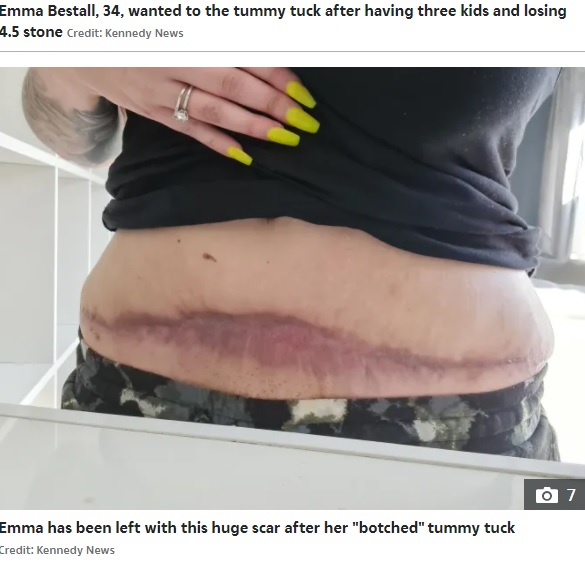 大きな傷が残ったエマさんの腹部（画像は『The Sun　2022年3月23日付「HORROR OP I look ‘butchered after botched’ ￡3,500 tummy tuck left me with giant hip-to-hip scar」（Credit: Kennedy News）』のスクリーンショット）