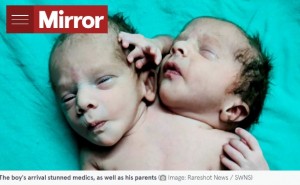 3月28日に誕生した結合双生児（画像は『The Mirror　2022年3月30日付「Baby born with two heads, three hands and two hearts after mum told to expect twins」（Image: Rareshot News / SWNS）』のスクリーンショット）