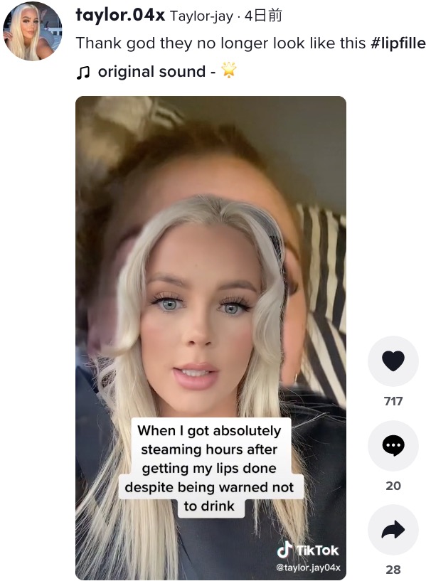 リップフィラー後の忠告を守らなかった女性（画像は『Taylor-jay　2022年4月12日付TikTok「Thank god they no longer look like this」』のスクリーンショット）