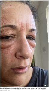 まるで出目金のように…（画像は『The Sun　2022年4月5日付「EYE CAN’T BELIEVE IT I spent ￡800 to get rid of my droopy eyelids but my face BALLOONED - my son couldn’t even look at me」（Credit: Kennedy News）』のスクリーンショット）