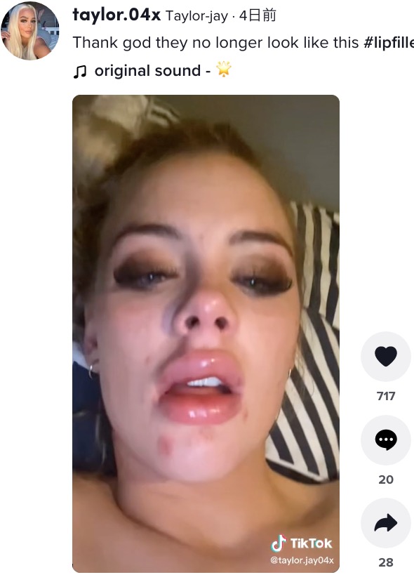 唇がひどく腫れてしまったテイラーさん（画像は『Taylor-jay　2022年4月12日付TikTok「Thank god they no longer look like this」』のスクリーンショット）