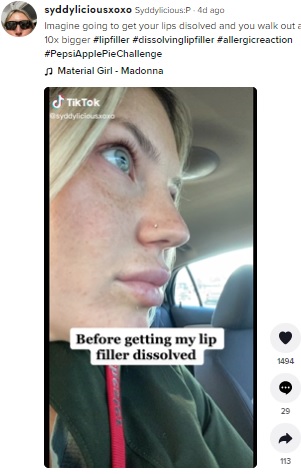 リップフィラー溶解剤を注入する前の女性（画像は『Syddylicious:P　2022年4月5日付TikTok「Imagine going to get your lips disolved and you walk out and they are 10x bigger」』のスクリーンショット）