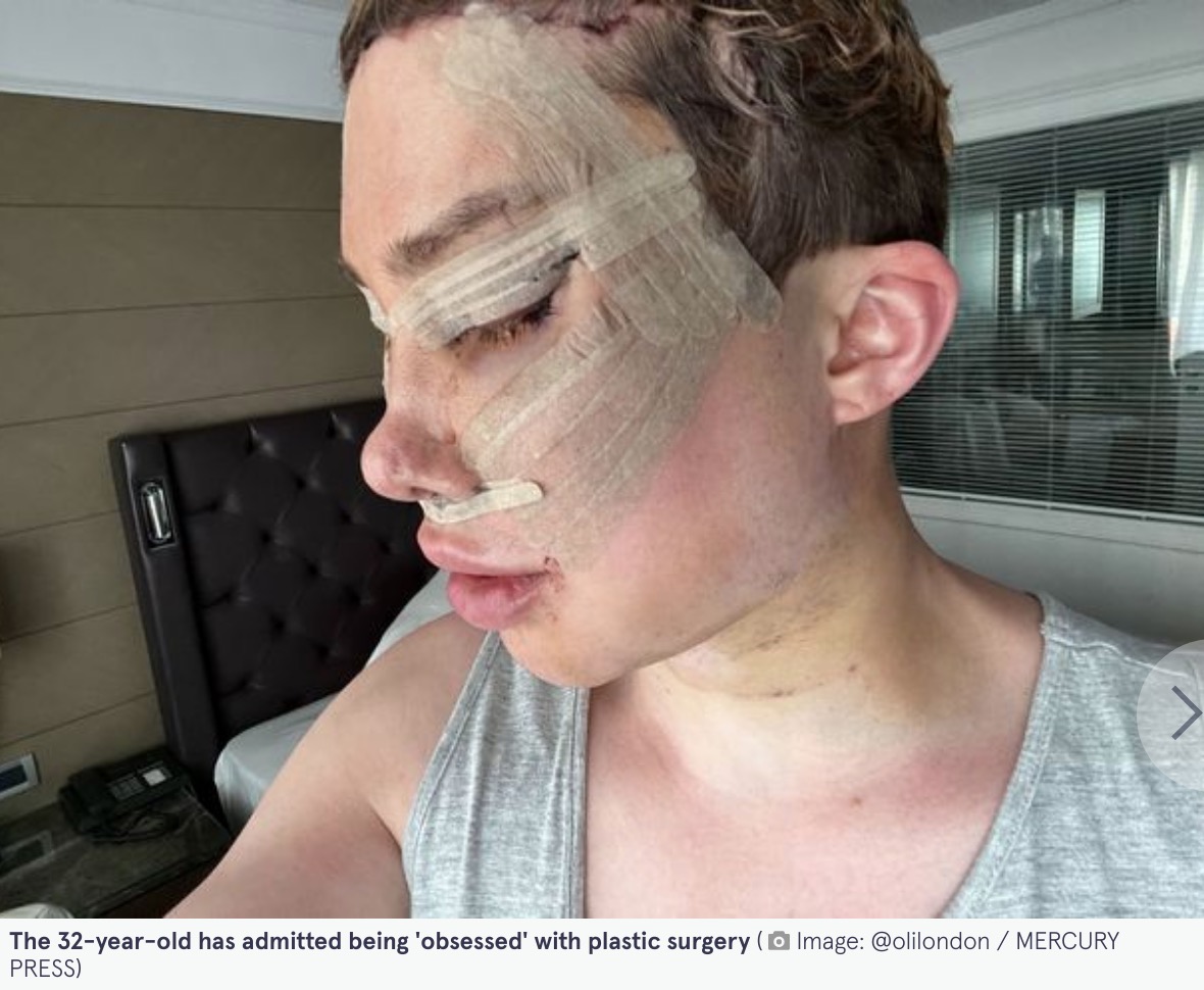 トルコにて手術直後のオリさん（画像は『The Mirror　2022年4月20日付「British man undergoes ￡230,000 plastic surgery to make himself look like Korean woman」（Image: ＠olilondon / MERCURY PRESS）』のスクリーンショット）