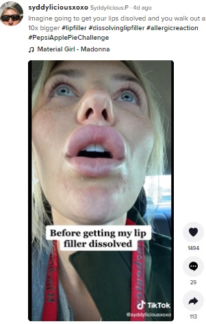 上下の唇が異様に腫れているシディさん（画像は『Syddylicious:P　2022年4月5日付TikTok「Imagine going to get your lips disolved and you walk out and they are 10x bigger」』のスクリーンショット）