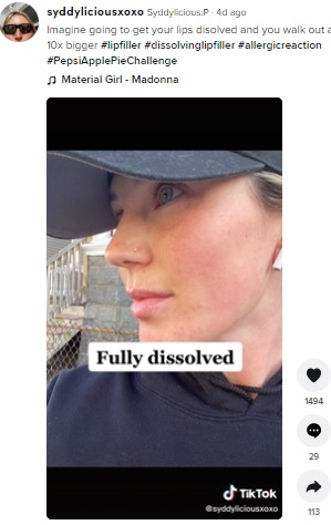 薬剤が完全に溶解した後のシディさん（画像は『Syddylicious:P　2022年4月5日付TikTok「Imagine going to get your lips disolved and you walk out and they are 10x bigger」』のスクリーンショット）