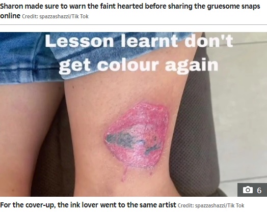 タトゥーが剥がれた後の脚（画像は『The Sun　2022年4月25日付「TATT’S SO GROSS I got a tattoo of lips on my leg…turns out I was allergic to the ink, the infection was so bad the thing peeled off」（Credit: spazzashazzi/Tik Tok）』のスクリーンショット）