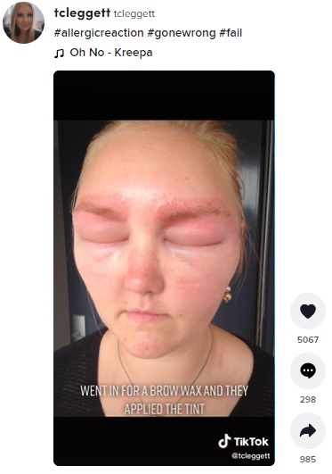 目が開けられなくなってしまったタミカさん（画像は『tcleggett　2022年4月17日付TikTok「＃allergicreaction ＃gonewrong ＃fail」』のスクリーンショット）