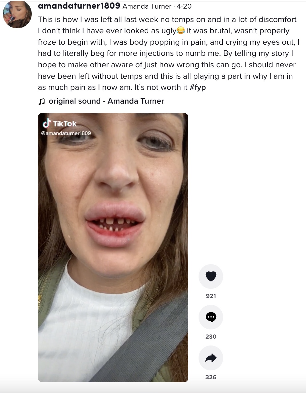 海外での歯科治療のリスクを語るアマンダさん（画像は『Amanda Turner　2022年4月20日付TikTok「This is how I was left all last week no temps on and in a lot of discomfort」』のスクリーンショット）