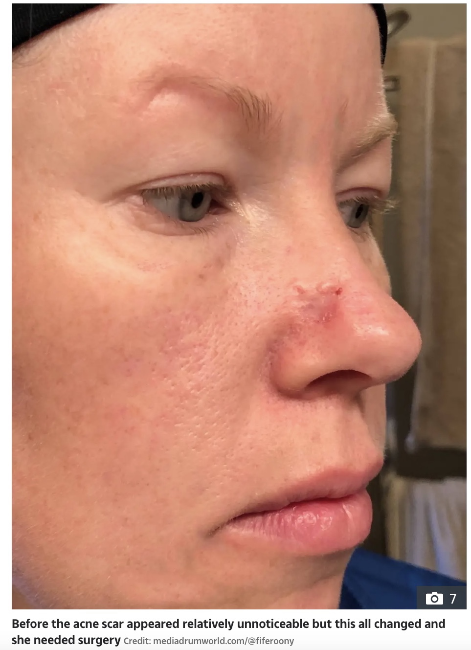 鼻のニキビ跡がなかなか治らなかったメリッサさん（画像は『The Sun　2022年5月31日付「MY ACNE HELL I had an acne scar and what happened next left me rocked to core」（Credit: mediadrumworld.com/＠fiferoony）』のスクリーンショット）