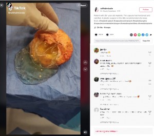 破損し漏れたジェル（画像は『Dr. Nicole Castellese　2022年4月14日付TikTok「Patient with 35+ year old implants.」』のスクリーンショット）