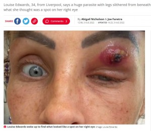 瞼が腫れ上がったルイーズさん（画像は『The Daily Star　2022年8月3日付「Mum felt sickening pop as ‘huge parasite slithered from beneath her eyelid’」（Image: Louise Edwards）』のスクリーンショット）