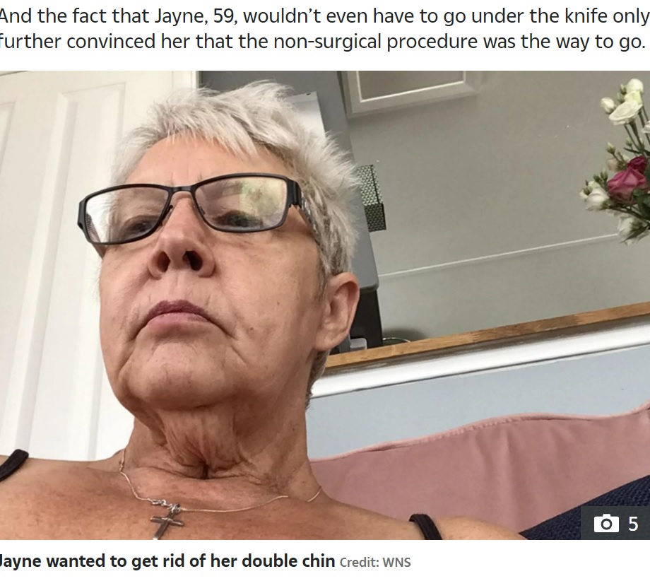 プラズマ治療でトラウマ体験をした女性（画像は『The Sun　2022年8月8日付「BOTCHED I paid ￡500 to get rid of my double chin, but I was left looking like an ‘old chicken’ ― now I barely leave the house」（Credit: WNS）』のスクリーンショット）