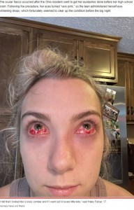 目の下に血溜まり？（画像は『New York Post　2022年8月24日付「I was left with ‘zombie’ eyes and blindness from botched eyelash extensions」（Kennedy News and Media）』のスクリーンショット）