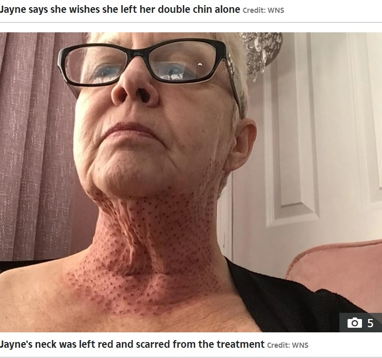 火傷したかのように腫れた首（画像は『The Sun　2022年8月8日付「BOTCHED I paid ￡500 to get rid of my double chin, but I was left looking like an ‘old chicken’ ― now I barely leave the house」（Credit: WNS）』のスクリーンショット）