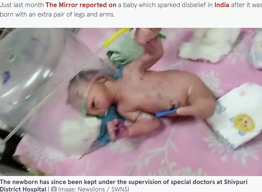 容体は安定しているという赤ちゃん（画像は『The Mirror　2022年8月29日付「Doctors stunned after a baby is born with a horn-like structure instead of legs」（Image: Newslions / SWNS）』のスクリーンショット）