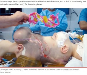 何度も練習を重ね手術へ（画像は『New York Post　2022年8月1日付「Conjoined twins born with fused brains separated after 27-hour surgery」（Gemini Untwined）』のスクリーンショット）