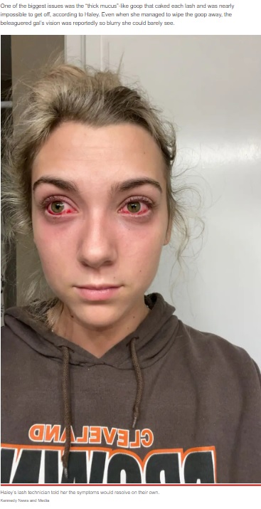 5週間も目が充血していたヘイリーさん（画像は『New York Post　2022年8月24日付「I was left with ‘zombie’ eyes and blindness from botched eyelash extensions」（Kennedy News and Media）』のスクリーンショット）