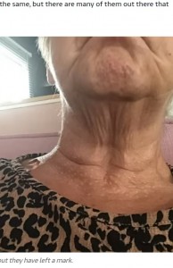 3年経っても傷跡が残っている首（画像は『ITV News　2021年10月13日付「Woman left with dozens of scars after botched beauty treatment now struggles to leave her home」』のスクリーンショット）