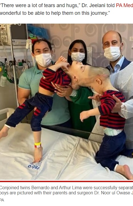 手術前の頭蓋結合双生児の兄弟（画像は『New York Post　2022年8月1日付「Conjoined twins born with fused brains separated after 27-hour surgery」（PA）』のスクリーンショット）