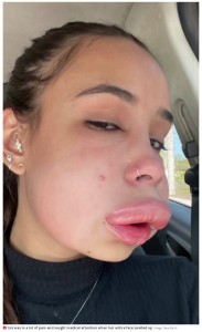 まるでスヌーピーのような顔に（画像は『The Daily Star　2022年9月19日付「Woman ‘nearly died’ as horror lip filler session left her ‘looking like Snoopy’」（Image: Newsflash）』のスクリーンショット）