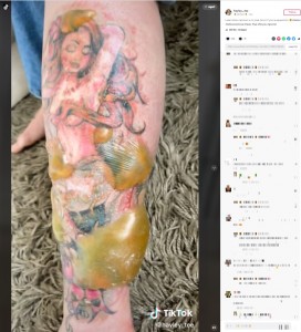 マーメイドの上に巨大な水ぶくれが（画像は『HAYLEY　2022年9月5日付TikTok「Laser tattoo removal is no joke.」』のスクリーンショット）