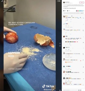 白い粉はカルシウム（画像は『Clayton Moliver, MD　2022年7月21日付TikTok「25-year-old implantBreast Implant Illness（BII）and severe capsular contracture.」』のスクリーンショット）