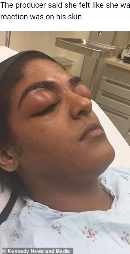 まるで昆虫？（画像は『Hot Fast News　2022年9月11日付「TV Producer Was Left With ‘Bug Eyes’ After Severe Allergic Reaction To Eyebrow Dye」（（C）Kennedy News and Media）』のスクリーンショット）