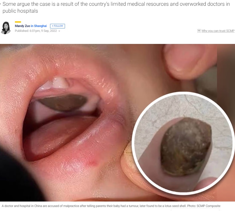 上あごの腫瘍は蓮の実の殻だった！（画像は『South China Morning Post　2022年9月9日付「Chinese baby with lotus seed shell stuck in mouth misdiagnosed with tumour, embroiling public health system in scandal」（Photo: SCMP Composite）』のスクリーンショット）