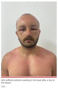 当初は目など顔も浮腫んでいたジャネルさん（画像は『New York Post　2022年8月30日付「Man stuns doctors after developing swollen head after day at beach」（CEN）』のスクリーンショット）