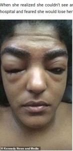 瞼が膨らみ始めたジャッキーさん（画像は『Hot Fast News　2022年9月11日付「TV Producer Was Left With ‘Bug Eyes’ After Severe Allergic Reaction To Eyebrow Dye」（（C）Kennedy News and Media）』のスクリーンショット）