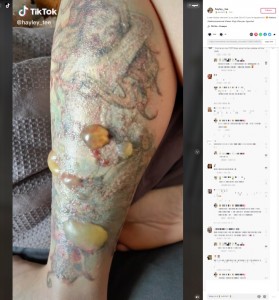 色褪せたタトゥーに小さな水ぶくれが！（画像は『HAYLEY　2022年9月5日付TikTok「Laser tattoo removal is no joke.」』のスクリーンショット）