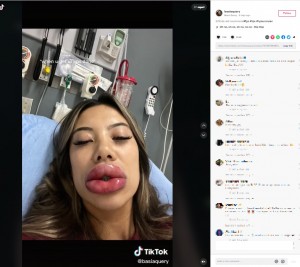 麻酔クリームにアレルギー反応を起こしたバーシャさん（画像は『Basia Query　2022年10月23日付TikTok「0/10 do not recommend」』のスクリーンショット）