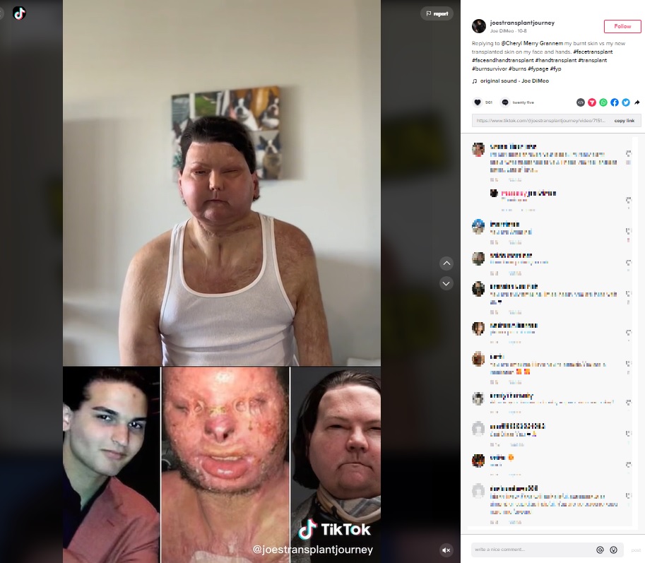 事故前、事故後、手術後についてTikTokで語るジョーさん（画像は『Joe DiMeo　2022年10月8日付TikTok「Replying to ＠Cheryl Merry Grannem」』のスクリーンショット）