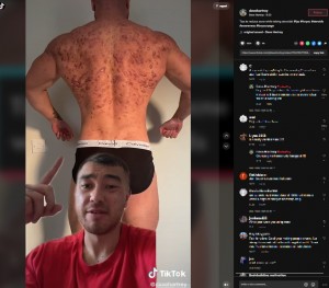 ステロイドを止めて1か月後（画像は『Dave Hartrey　2022年8月23日付TikTok「Tips to reduce acne while taking steroids!」』のスクリーンショット）