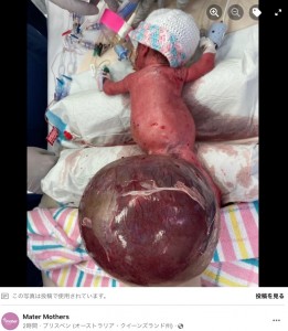 新生児の身体の2倍もある腫瘍（画像は『Mater Mothers 2022年11月6日付Facebook「Mater doctors have saved the life of a premature baby girl after successfully removing a two- kilogram tumour from a tiny newborn’s spine.」』のスクリーンショット）