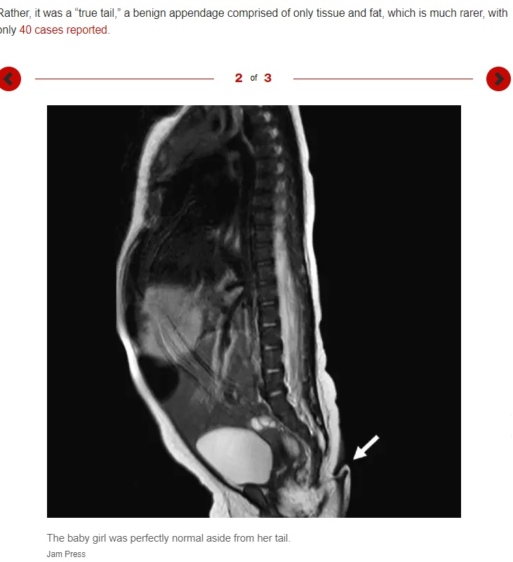 臀部から生えた尻尾（画像は『New York Post　2022年11月25日付「Baby girl born perfectly normal — except for ‘extremely rare’ tail」（Jam Press）』のスクリーンショット）