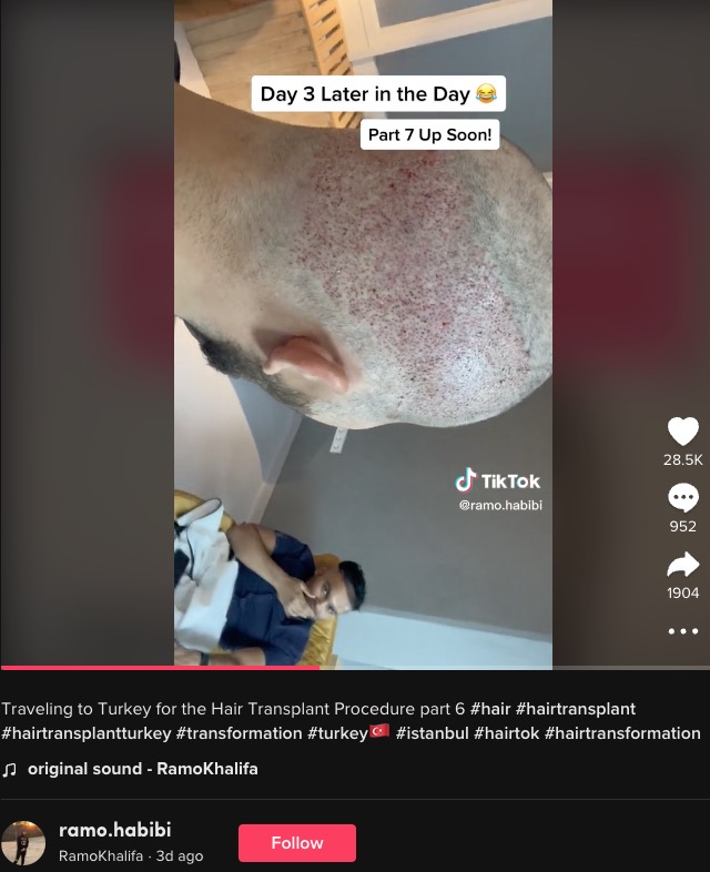 後頭部の髪を前頭部に植毛（画像は『RamoKhalifa　2022年12月1日付TikTok「Traveling to Turkey for the Hair Transplant Procedure part 6」』のスクリーンショット）