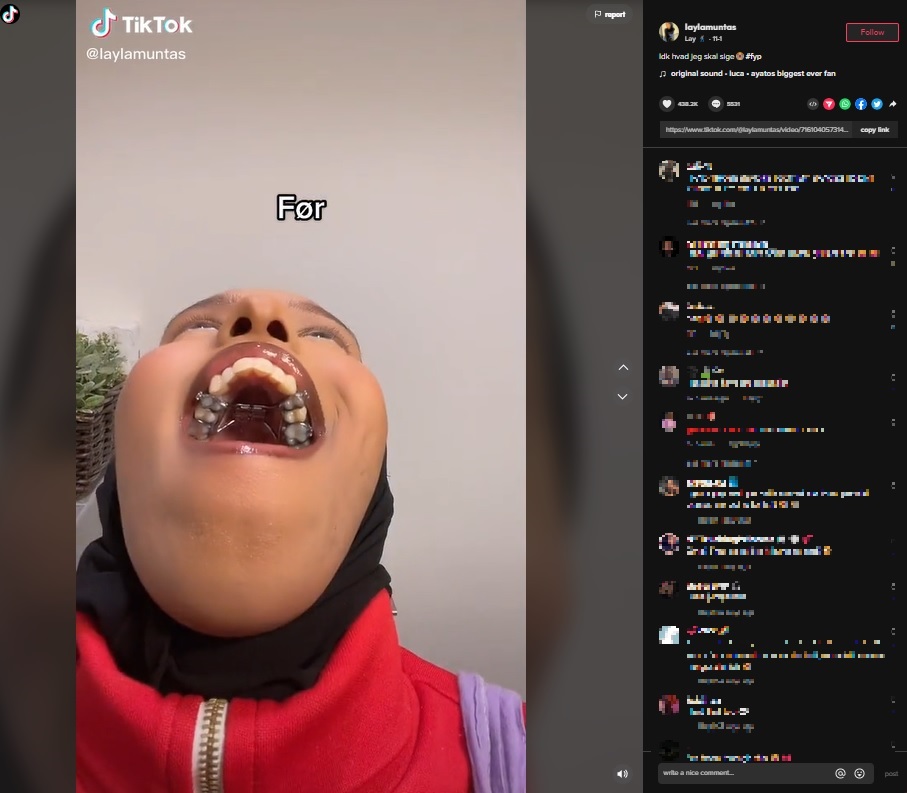 上顎に付けた拡大装置（画像は『Lay　2022年11月1日付TikTok「Idk hvad jeg skal sige」』のスクリーンショット）