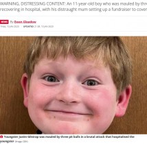 【海外発！Breaking News】自転車に乗っていた11歳男児、ピットブル3頭に襲われ頭皮の70％を失う重傷（米）