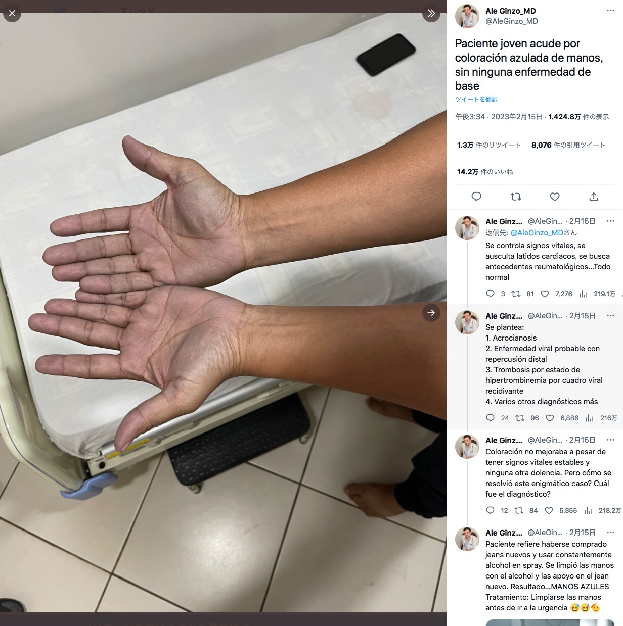 男性の青い手（画像は『Ale Ginzo_MD　2023年2月15日付Twitter「Paciente joven acude por coloración azulada de manos,」』のスクリーンショット）