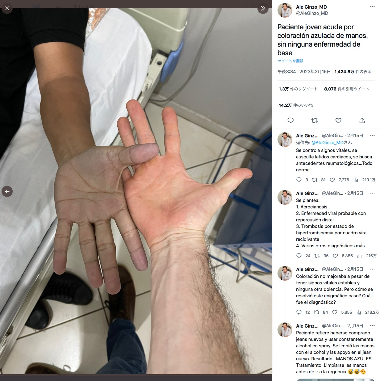 医師が診断した男性の青い手（左）（画像は『Ale Ginzo_MD　2023年2月15日付Twitter「Paciente joven acude por coloración azulada de manos,」』のスクリーンショット）