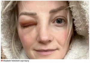 今も後遺症が残るエリザベスさん（画像は『WalesOnline　2023年2月12日付「Mum suffered freak ‘Final Destination’ injury when broken fish tank pierced her eyeball」』のスクリーンショット）