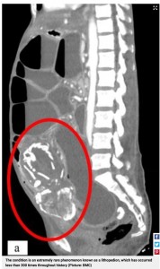 女性の腹部には石灰化した胎児が（画像は『Metro　2023年3月10日付「Woman died of starvation after carrying unborn foetus inside her for nine years」（Picture: BMC）』のスクリーンショット）