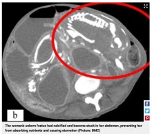【海外発！Breaking News】石灰化した胎児を9年間も腹部に抱えていた女性、栄養失調で死亡（米）