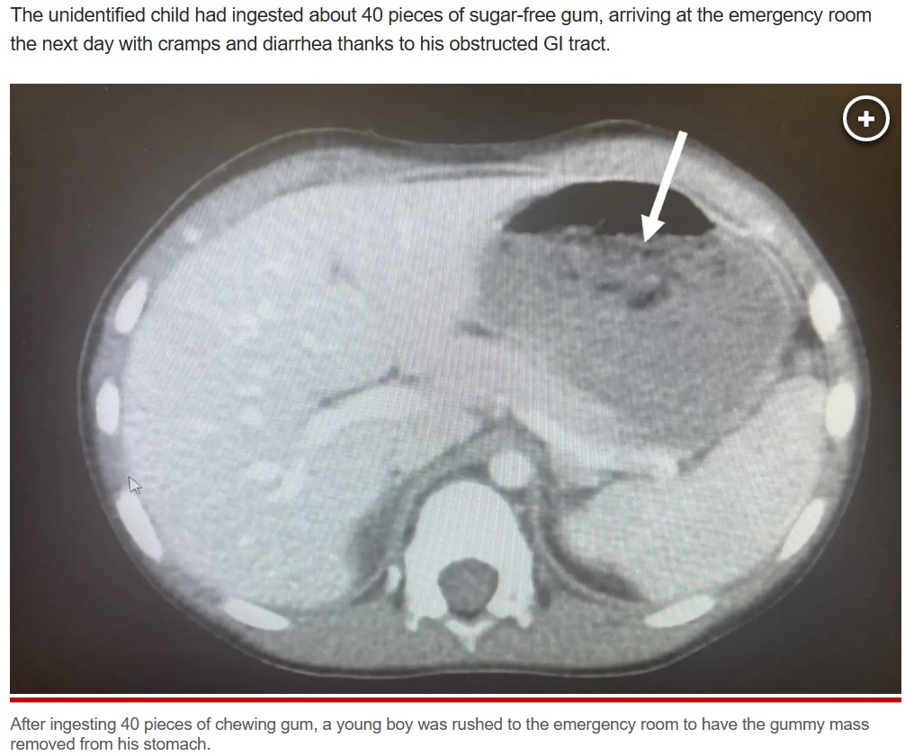 腹痛と下痢の症状を訴える5歳男児、CT検査で胃部に大きな影が確認された。男児は前日に40粒のガムを飲み込んでしまったという（画像は『New York Post　2023年5月27日付「My 5-year-old swallowed 40 pieces of gum ― here’s what happened next」（Science Direct）』のスクリーンショット）