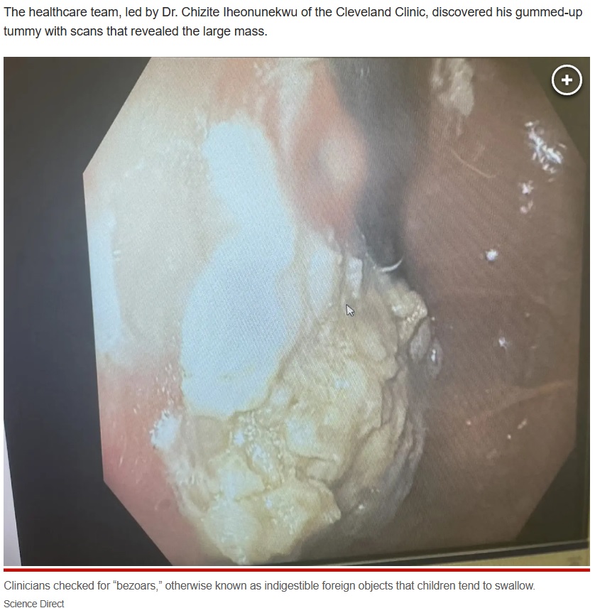 胃カメラで男児の胃内部を確認すると、40粒のガムが大きな塊となっていることが分かった。内部でガムの塊を分解し、複数回に分けて摘出したという（画像は『New York Post　2023年5月27日付「My 5-year-old swallowed 40 pieces of gum ― here’s what happened next」（Science Direct）』のスクリーンショット）