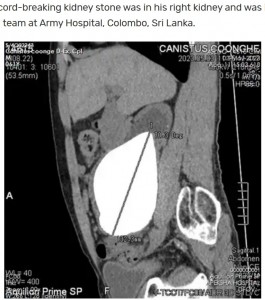 結石の長さは13.37センチで、男性の腎臓よりも大きくなっていた。この結石は世界最大の腎臓結石として、19年ぶりに記録を更新した（画像は『Guinness World Records　2023年6月15日付「World’s largest and heaviest kidney stone removed from Sri Lankan man」』のスクリーンショット）