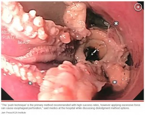 医療チームはタコの処置に苦労したものの、最終的に鉗子を用いてタコの頭を掴んで胃の中へ引っ張り、食道の詰まりを解消したという（画像は『New York Post　2023年7月5日付「Doctors flabbergasted after finding octopus in patient’s throat」（Jam Press/AGA Institute）』のスクリーンショット）