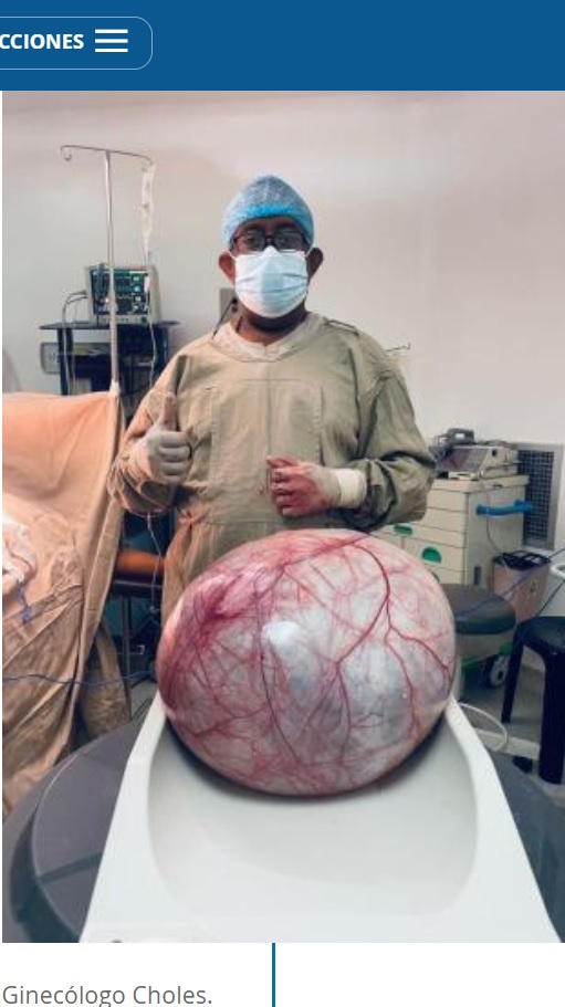 摘出された腫瘍は良性で約12キロにもなった。これは腫瘍の中に液体が溜まる「卵巣嚢腫（卵巣漿液性嚢胞腺腫）」の重症なケースで、アルバラド医師の患者の中では最大だったという（画像は『El Tiempo　2023年7月16日付「Extraen un tumor de 12 kilos a una mujer en el municipio de Uribia, La Guajira」（FOTO: Portal La Guajira Hoy）』のスクリーンショット）