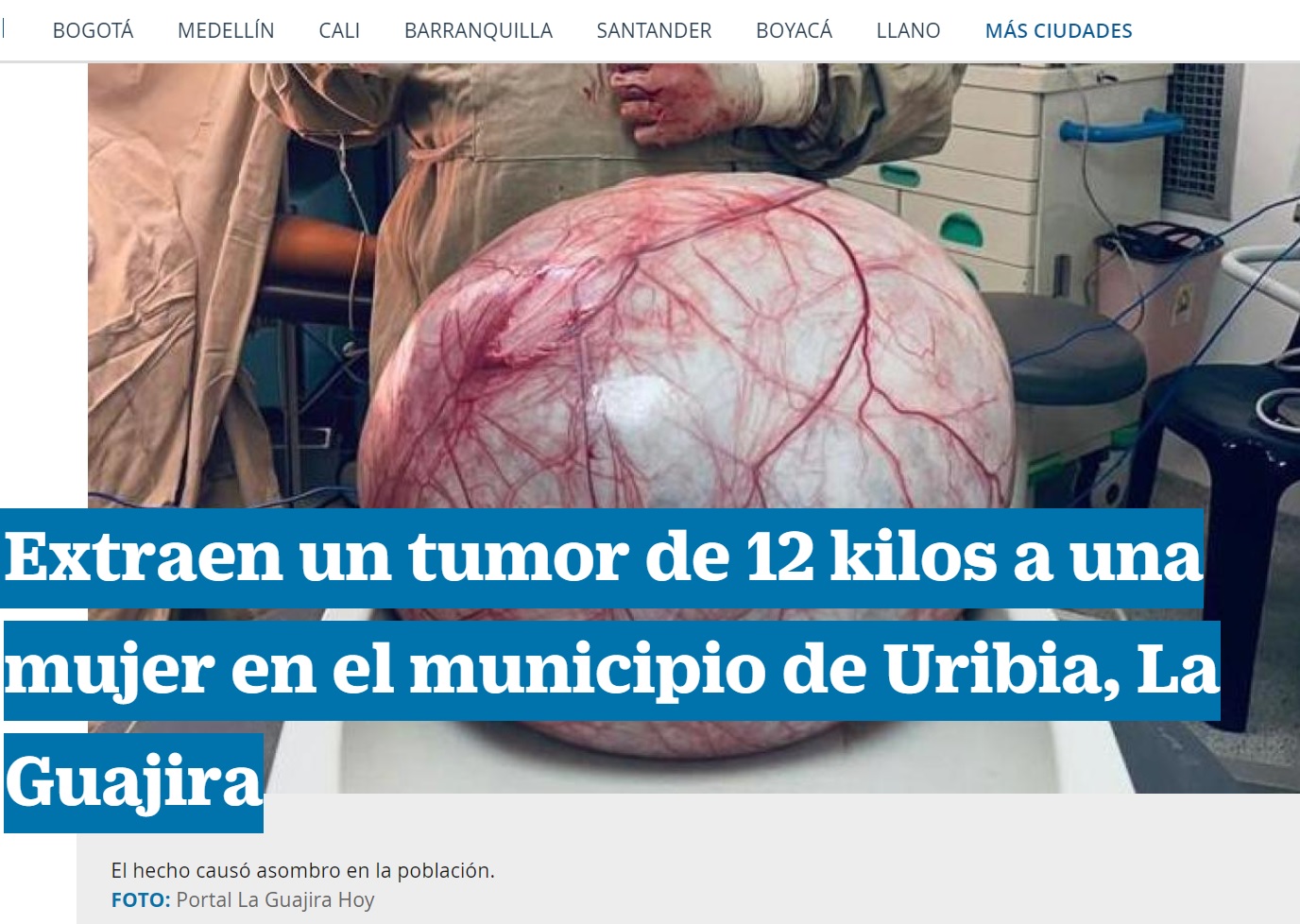 約10時間をかけて摘出された腫瘍は、充血した白目を巨大化したようにも見える。女性は翌日には退院しており、「これまでは歩くのも動くのも大変でしたが、手術で重荷が取り除かれました」と述べていた（画像は『El Tiempo　2023年7月16日付「Extraen un tumor de 12 kilos a una mujer en el municipio de Uribia, La Guajira」（FOTO: Portal La Guajira Hoy）』のスクリーンショット）